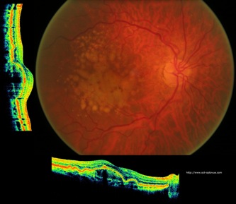 oct optovue drusen druses maculaires