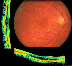 drusen retinopathy druses retinopathie