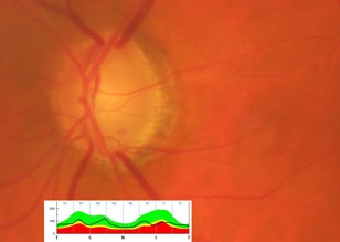 oct glaucoma hémorragie glaucome rnfl