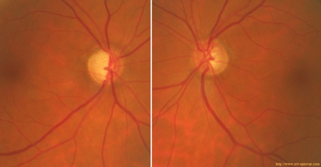 glaucoma glaucome papilles excavées