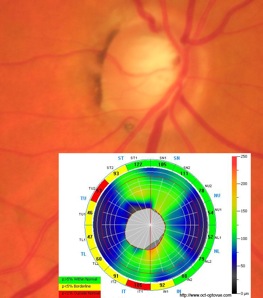 glaucome papille oct rnfl