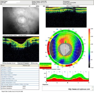 rnfl glaucome glaucoma optovue oct