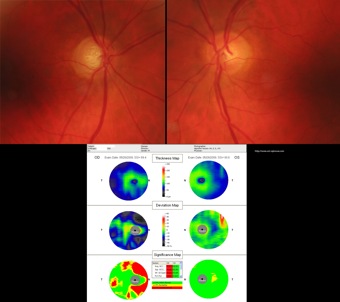 oct glaucoma unilateral gcc optovue