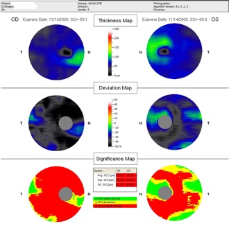 gcc glaucoma optovue glaucome