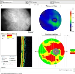 glaucome glaucoma gcc pathology