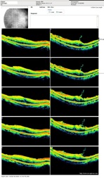 epiretinal membrane oct optovue epimacular