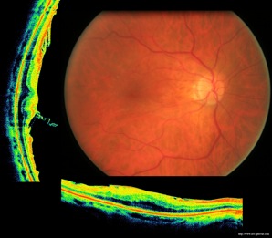 epiretinal membrane oct optovue epimacular