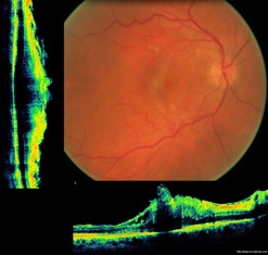 epiretinal membrane oct optovue epimacular