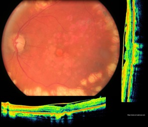 oct mer membrane epimaculaire epimacular