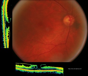 epiretinienne membrane mer optovue