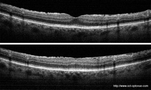 membrane épirétinienne oct mer
