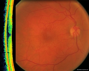 epiretinal membrane oct optovue epimacular