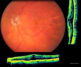 oct jaffe membrane épimaculaire epimacular epiretinal