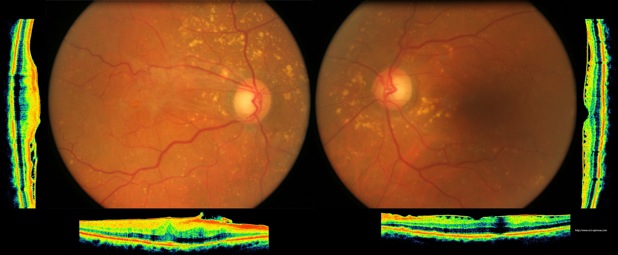 oct mer membrane epimaculaire epimacular