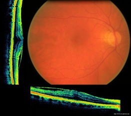 epiretinal membrane oct optovue epimacular