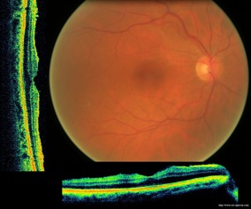 epiretinal membrane oct optovue epimacular