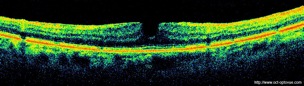 pseudo-trou maculaire pseudo macular hole