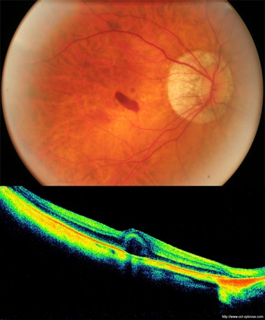 hemorragie maculaire myopie myopia hemorragia