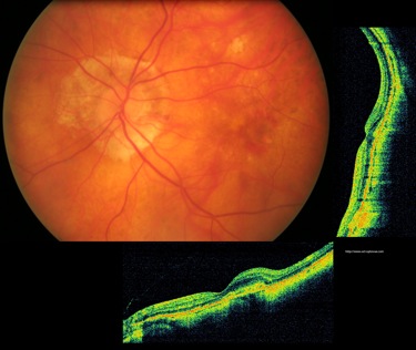 myopie myopia maculopathie néovaisseaux