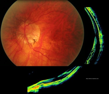 myopia myopie schisis oct