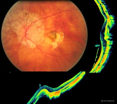  myopie myopia maculopathie