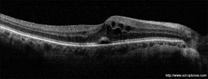 omc oedème rétinien oct optovue