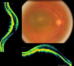 oct melanome melanoma retina retine