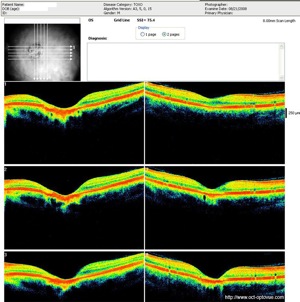 toxoplasmose oct retine optovue