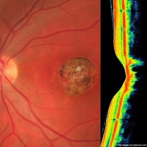 toxoplasmose oct retine retina toxo optovue