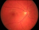 fond d'oeil normal eye fundus retine retina