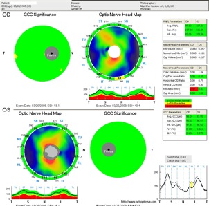 oct glaucoma glaucome rnfl gcc version 4 optovue