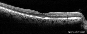 retine normale normal retina