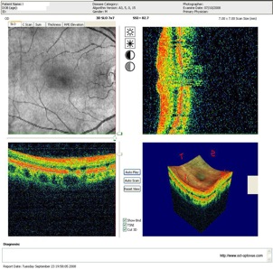 normal eye fundus retine retina slo