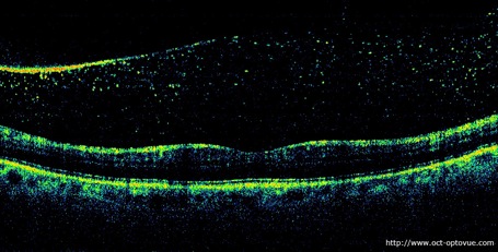 oct vitreous aster asteroid hyalosis synchisis