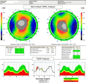 glaucome glaucoma rnfl optovue oct