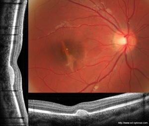 contusion rpe retine retina trauma oct