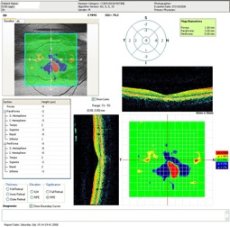 contusion rpe retine retina trauma oct