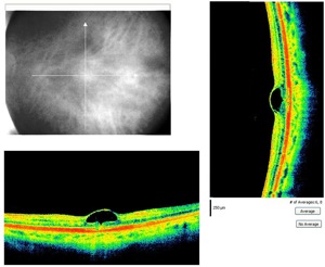 trou maculaire kyste foveolaire hole retina
