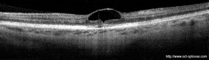 kyste foveolaire trou maculaire retina
