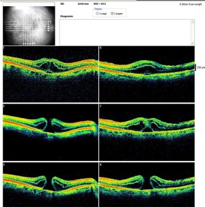 trou maculaire retina optovue oct hole