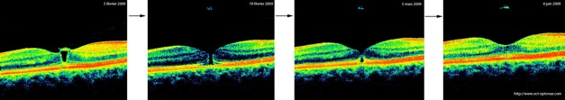 oct evolution trou maculaire macular hole