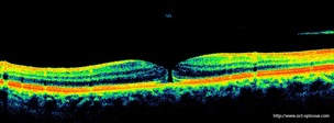 oct macular hole trou maculaire stade 3