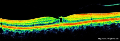 oct menace trou maculaire macular hole threat