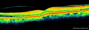 oct menace trou maculaire macular hole