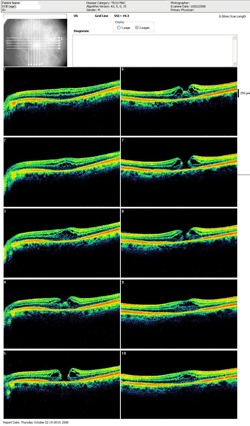 trou maculaire retina optovue oct hole
