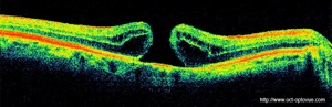 trou maculaire retina hole oct optovue