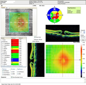 trou maculaire topography topographie retinal hole