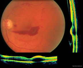 retina hemorrhage hémorragie pré-rétinienne oct