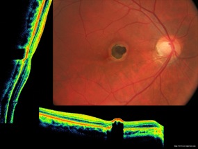 néovaisseaux jeune laser retine retina