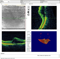 oct occlusion veineuse veinous